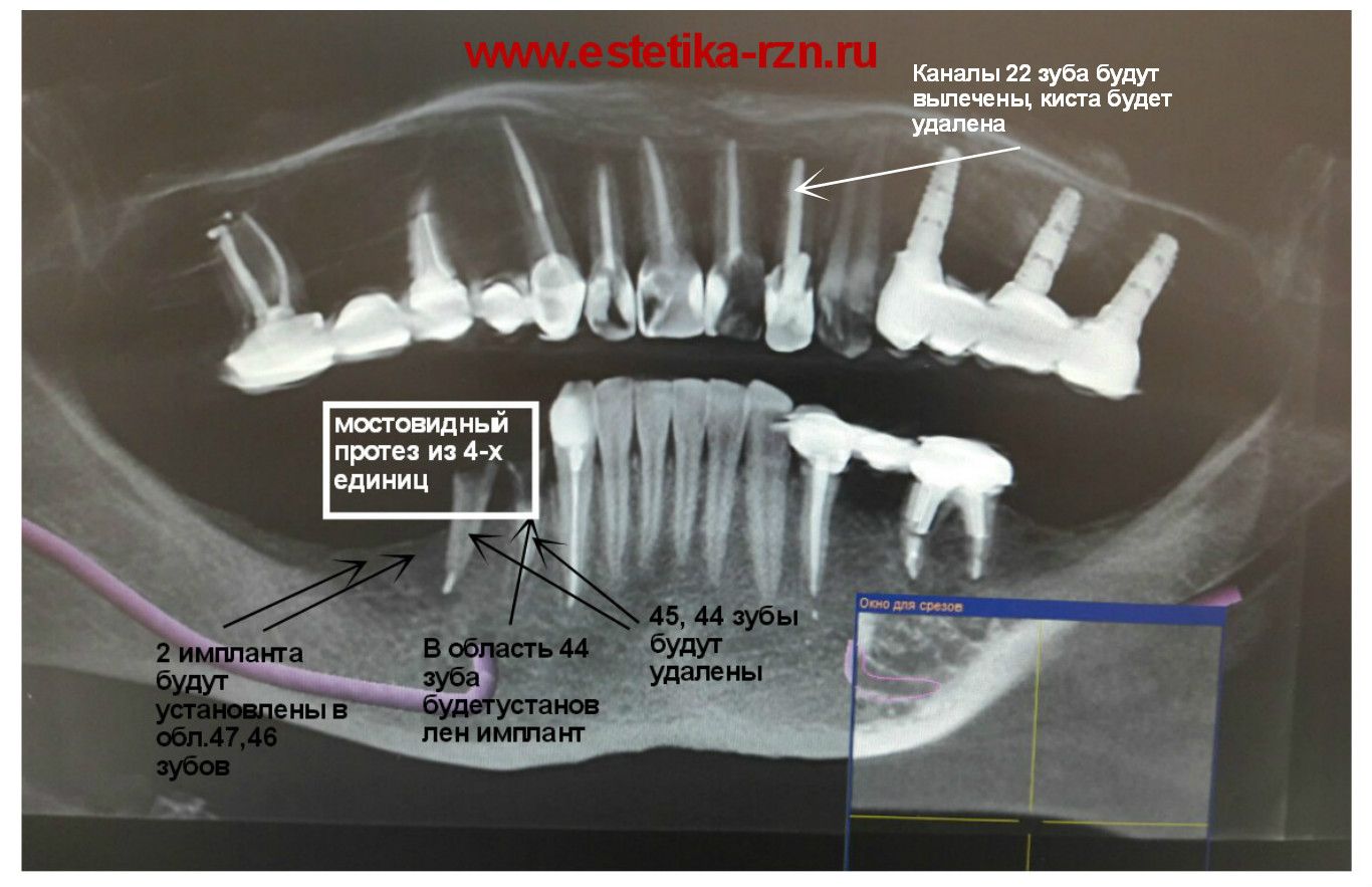Корни зубов нижней челюсти